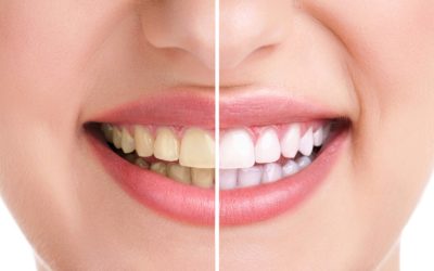 4 aliments qui blanchissent naturellement les dents